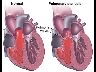 imagine cu stenoza pulmonara